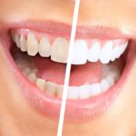 Aparat za poliranje i izbeljivanje zuba – Luma Smile 5